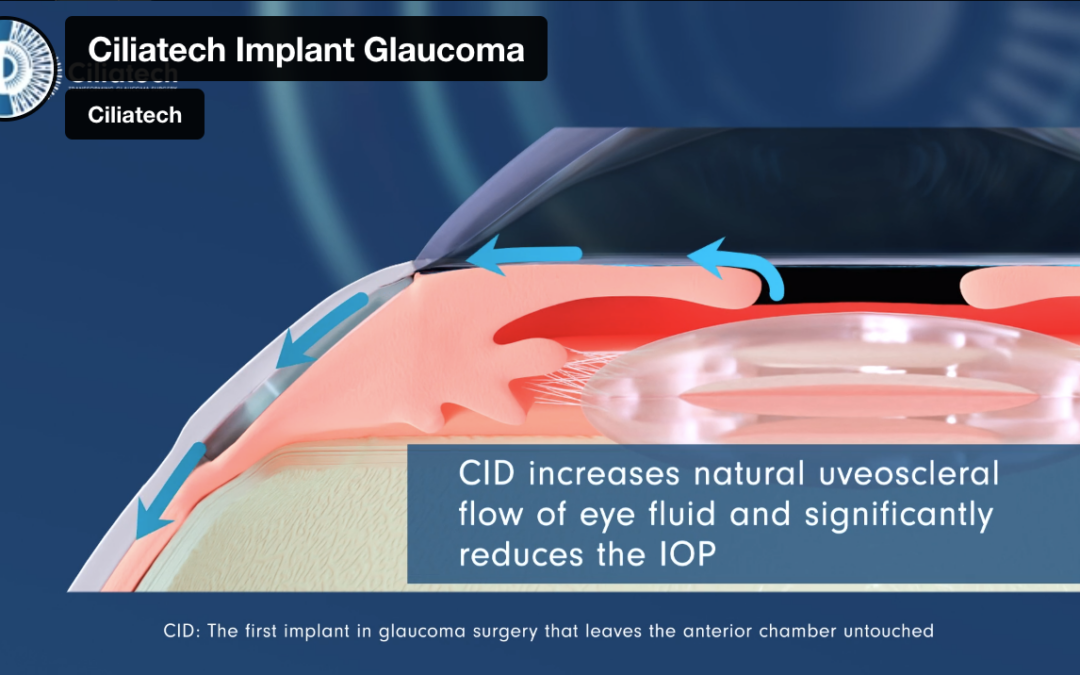 Ciliatech reports positive clinical results on novel glaucoma implant, CID, in 24-month post-operative follow-up